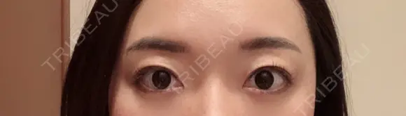 二重埋没 水の森美容クリニック 東京銀座院 DAY 7 メイン用