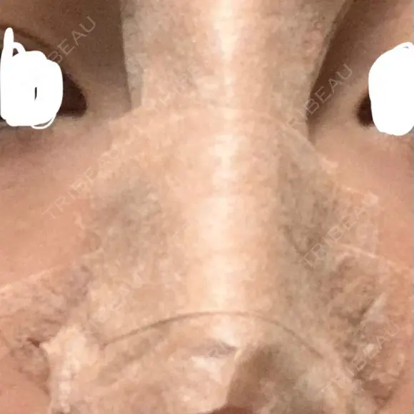 隆鼻術 アネシス美容クリニック DAY 0 メイン用