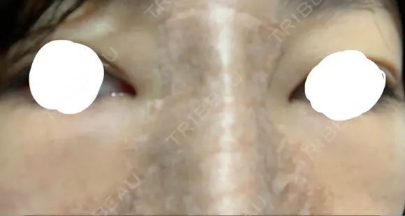 隆鼻術 アネシス美容クリニック DAY 2 メイン用