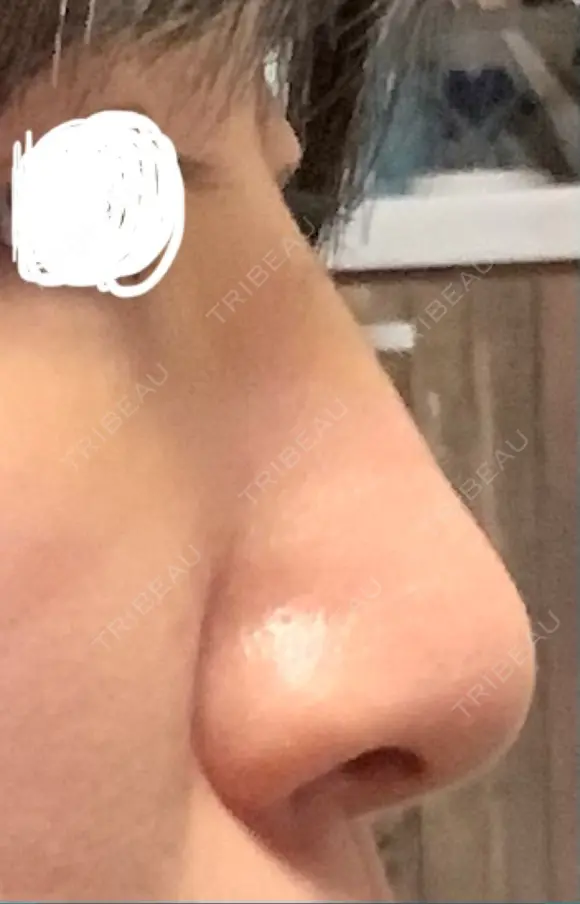 隆鼻術 アネシス美容クリニック DAY 4 メイン用