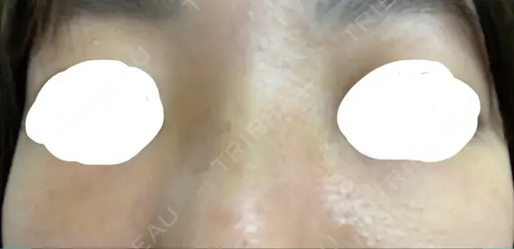 隆鼻術 アネシス美容クリニック DAY 4 メイン用