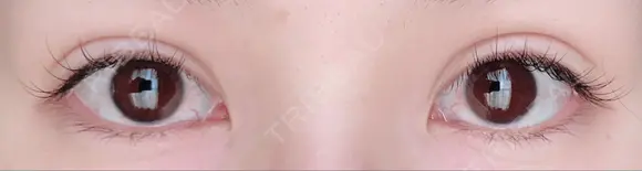 二重埋没 湘南美容クリニック 千葉センシティ院 DAY 182 メイン用