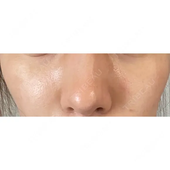シミ取りレーザー / ピコレーザートーニング（美白・肝斑） UB CLINIC銀座 AFTER メイン用