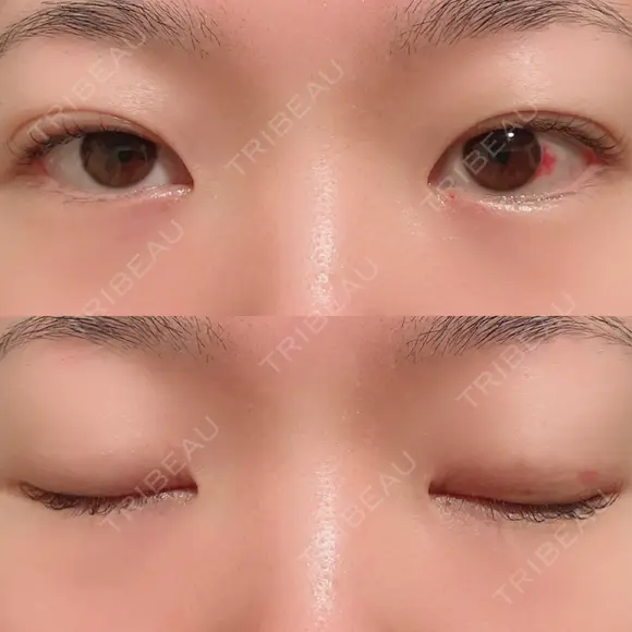 二重埋没 / 上まぶたの脂肪取り 湘南美容クリニック 水戸院 DAY 31 メイン用