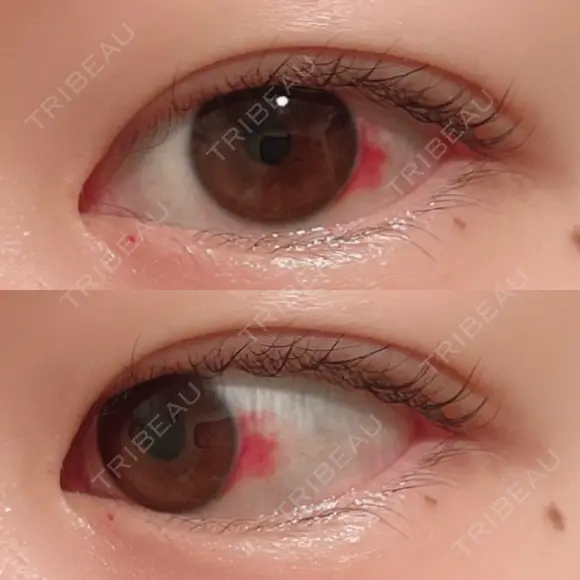 二重埋没 / 上まぶたの脂肪取り 湘南美容クリニック 水戸院 DAY 31 メイン用