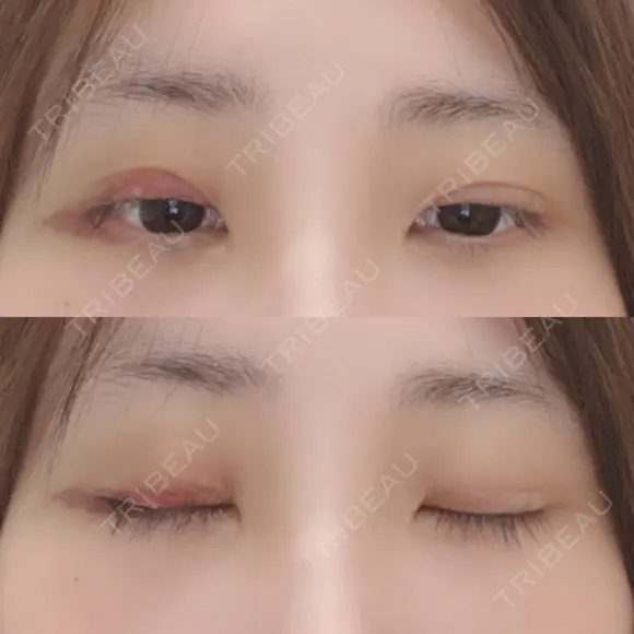 二重埋没 / 下まぶたの脂肪取り 湘南美容クリニック 宇都宮院 DAY 2 メイン用