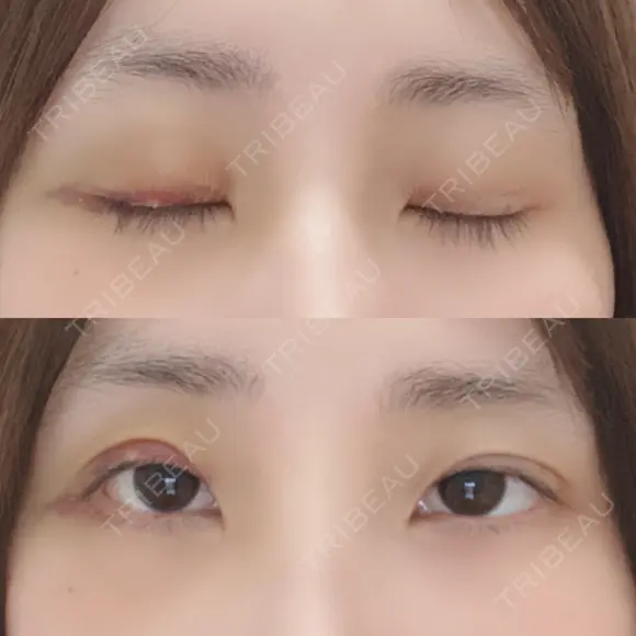 二重埋没 / 下まぶたの脂肪取り 湘南美容クリニック 宇都宮院 DAY 3 メイン用
