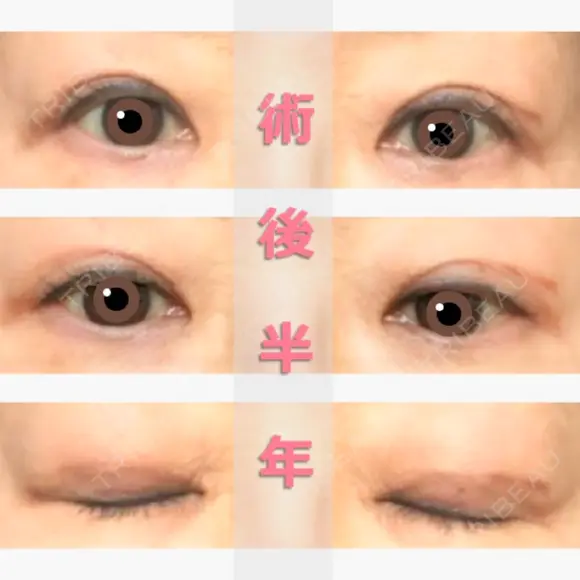 二重切開 / 上まぶたたるみ取り 表参道スキンクリニック 表参道院 AFTER メイン用