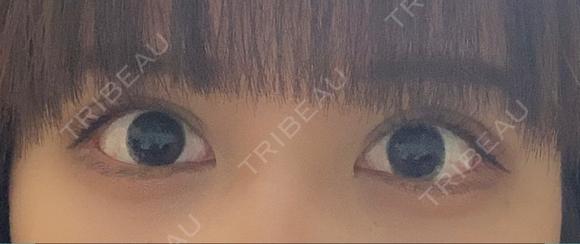 二重切開 / 上まぶたたるみ取り 酒井形成外科 DAY 21 メイン用
