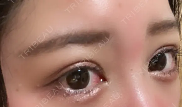 二重埋没 / 目頭切開 / 目尻切開 / タレ目形成・グラマラスライン（切開） HAAB×DREAM BEAUTY CLINIC 東京本院 DAY 9 メイン用