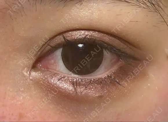 二重埋没 / 目頭切開 / 目尻切開 / タレ目形成・グラマラスライン（切開） HAAB×DREAM BEAUTY CLINIC 東京本院 DAY 9 メイン用