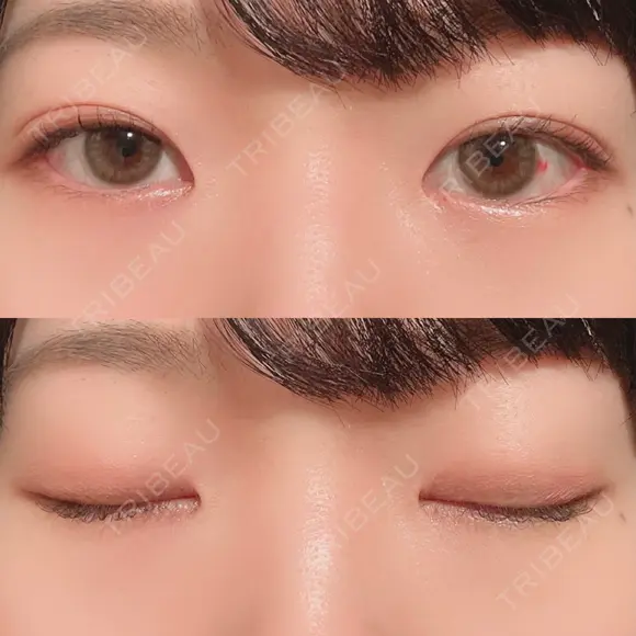 二重埋没 / 上まぶたの脂肪取り 湘南美容クリニック 水戸院 DAY 34 メイン用