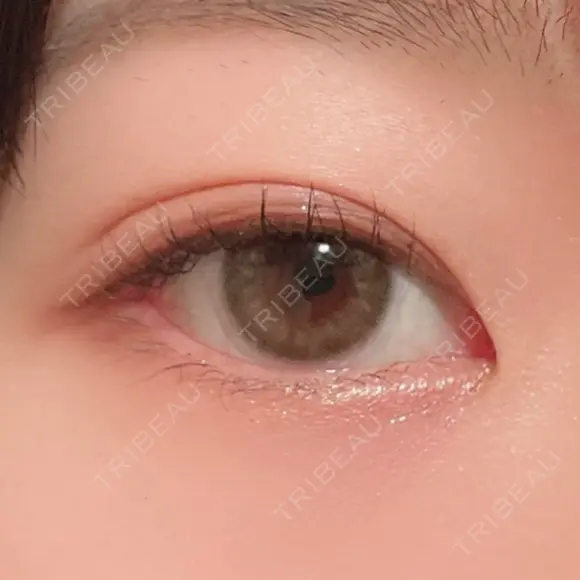 二重埋没 / 上まぶたの脂肪取り 湘南美容クリニック 水戸院 DAY 34 メイン用