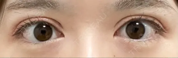 二重切開 恵聖会クリニック 心斎橋院 DAY 84 メイン用