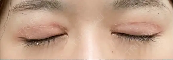 二重切開 恵聖会クリニック 心斎橋院 DAY 84 メイン用