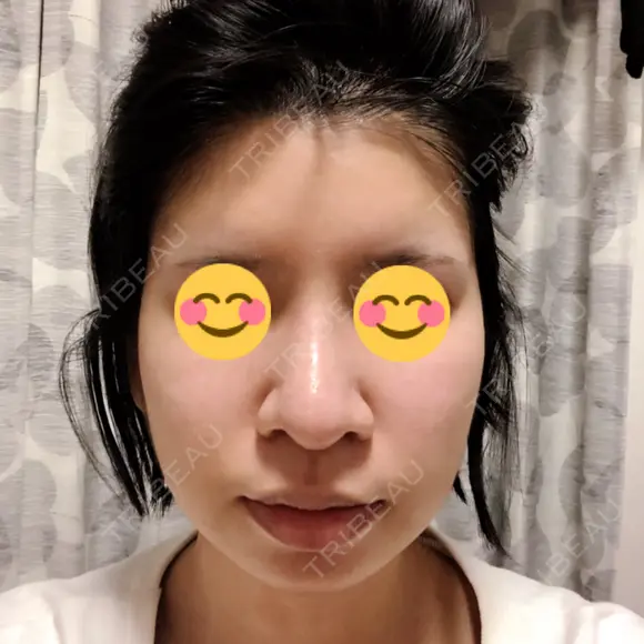 隆鼻術 / 鼻尖形成（切開） / 鼻中隔延長（切開） / 骨切幅寄せ 表参道スキンクリニック 表参道院 DAY 27 メイン用