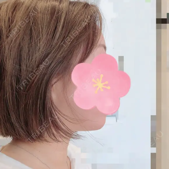 脂肪吸引（顔） 北尾クリニック DAY 41 メイン用