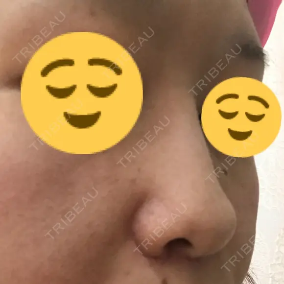 小鼻縮小（切開） / その他（鼻） 湘南メディカル記念病院（両国） DAY 71 メイン用