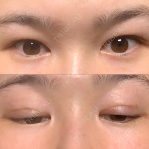 二重埋没 / 二重切開 宇都宮竹内クリニック DAY 41 メイン用