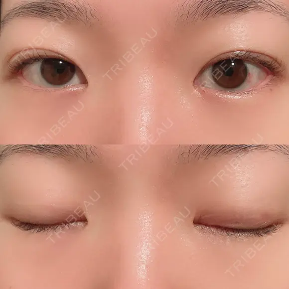 二重埋没 / 上まぶたの脂肪取り 湘南美容クリニック 水戸院 AFTER メイン用