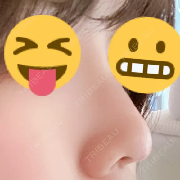 ヒアルロン酸注入（鼻） 品川美容外科 名古屋院 DAY 3 メイン用
