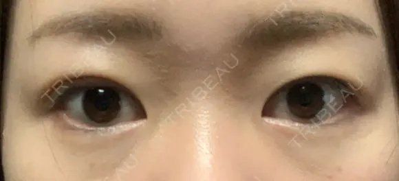 二重埋没 ハナキクリニック DAY 4 メイン用