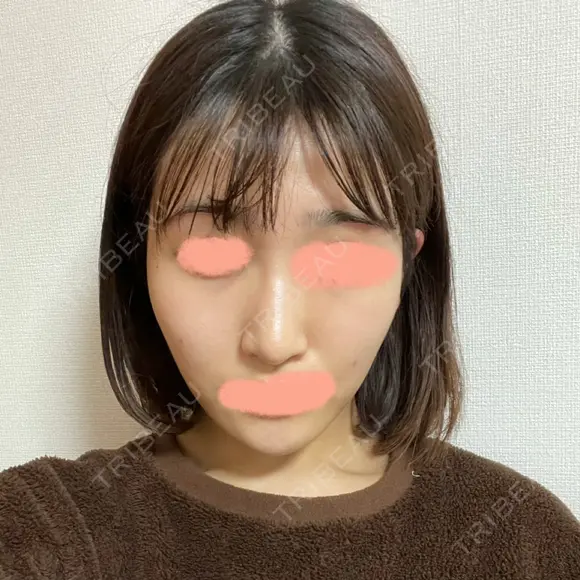糸リフト / バッカルファット除去 / 脂肪吸引（顔） / ボトックス（エラ・小顔） WOM CLINIC GINZA （ワム クリニック ギンザ） DAY 83 メイン用