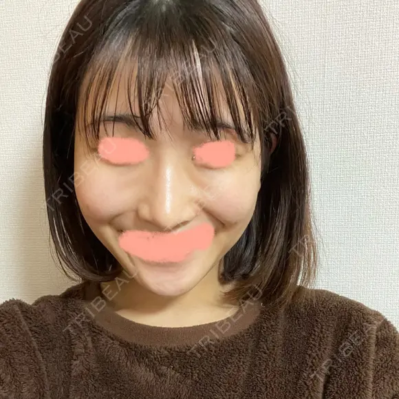 糸リフト / バッカルファット除去 / 脂肪吸引（顔） / ボトックス（エラ・小顔） WOM CLINIC GINZA （ワム クリニック ギンザ） DAY 83 メイン用