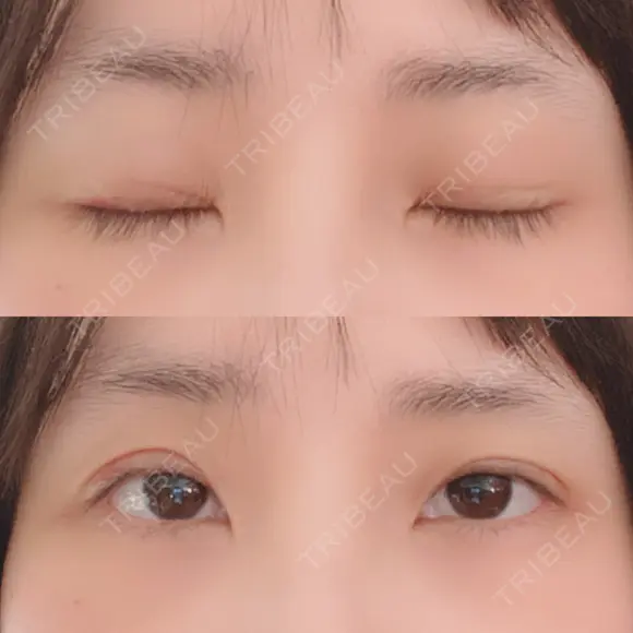 二重埋没 / 下まぶたの脂肪取り 湘南美容クリニック 宇都宮院 AFTER メイン用