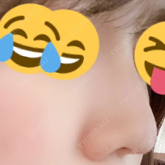 ヒアルロン酸注入（鼻） 品川美容外科 名古屋院 DAY 4 メイン用
