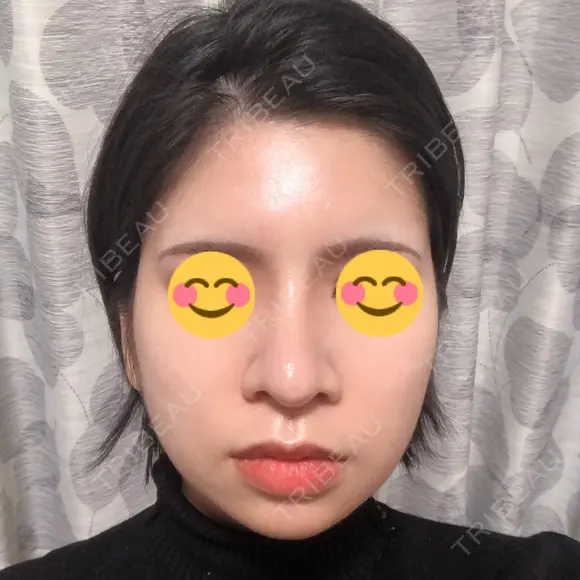 隆鼻術 / 鼻尖形成（切開） / 鼻中隔延長（切開） / 骨切幅寄せ 表参道スキンクリニック 表参道院 DAY 30 メイン用