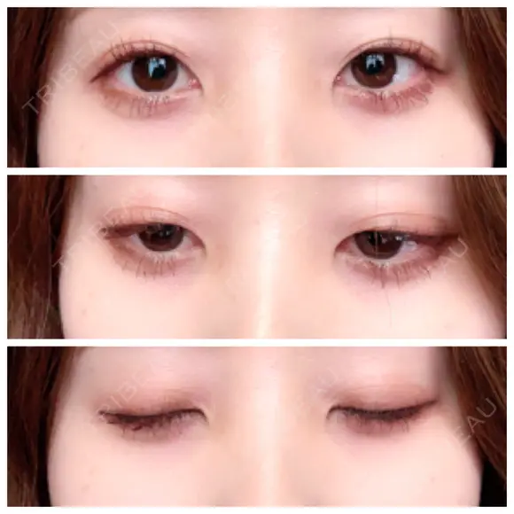 二重埋没 / 眼瞼下垂（切開） / クマ治療 / 下まぶたの脂肪取り THE MEDICAL SALON DAY 472 メイン用