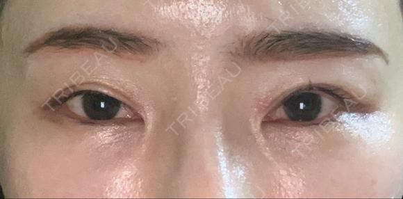 二重切開 / 眼瞼下垂（切開） / クマ治療 / 上まぶたたるみ取り / 眉下切開 くさのたろうクリニック AFTER メイン用