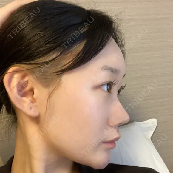 ヒアルロン酸注入（頬） 赤坂プレミアクリニック AFTER メイン用