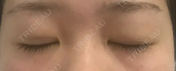 二重埋没 ハナキクリニック DAY 7 メイン用