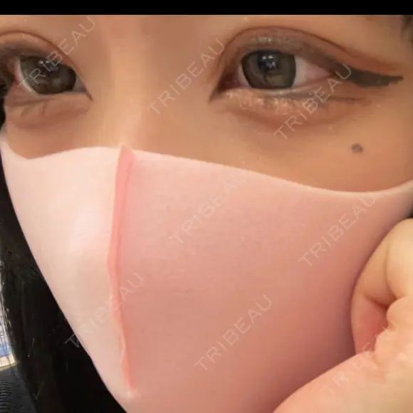 ヒアルロン酸注入（涙袋） イデア美容皮膚科クリニック 千葉船橋院 AFTER メイン用