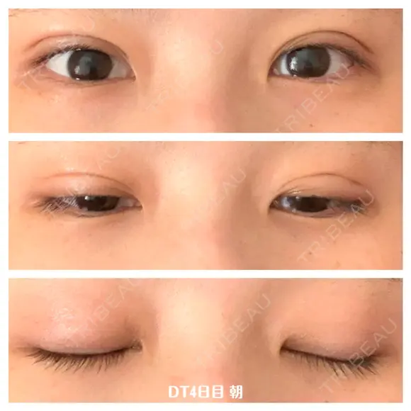 二重埋没 湘南美容クリニック 藤沢院 DAY 4 メイン用