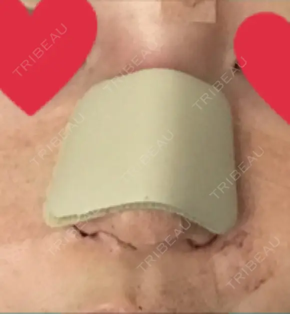 隆鼻術 / 鼻尖形成（切開） / 小鼻縮小（切開） / ほくろ・いぼ切除（肌） / 鼻翼挙上 東京形成美容外科 船橋院 DAY 0 メイン用