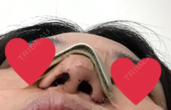 隆鼻術 / 鼻尖形成（切開） / 小鼻縮小（切開） / ほくろ・いぼ切除（肌） / 鼻翼挙上 東京形成美容外科 船橋院 DAY 0 メイン用