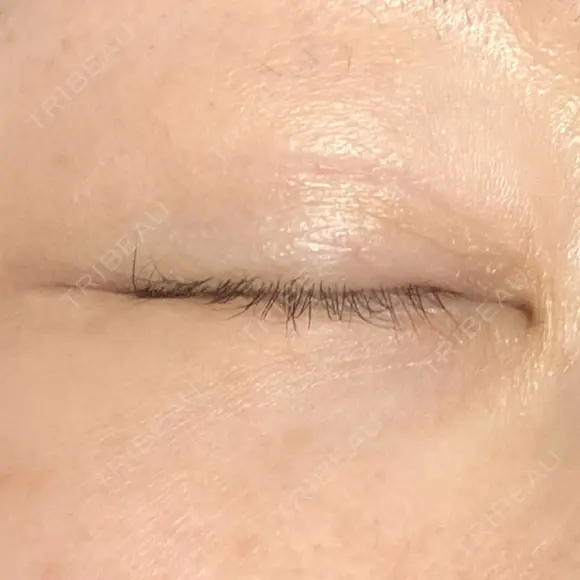 二重切開 / 眼瞼下垂（切開） / 上まぶたの脂肪取り / タレ目形成・グラマラスライン（切開） / 目尻靭帯移動 エイペックス美容外科 DAY 197 メイン用