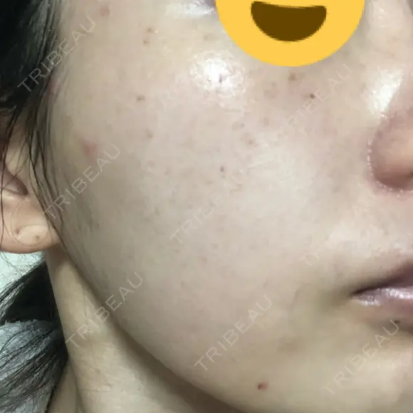 美肌レーザー / シミ取りレーザー たかはし形成外科･美容外科  DAY 3 メイン用