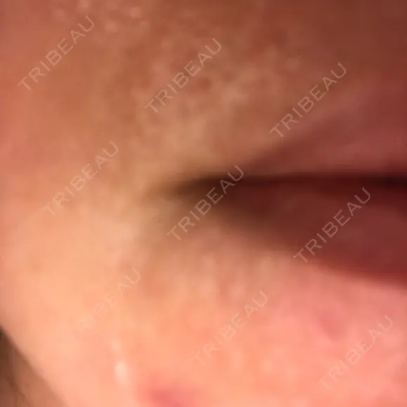 ほくろ・いぼ除去レーザー（肌） メディアージュクリニック 代官山院 DAY 7 メイン用