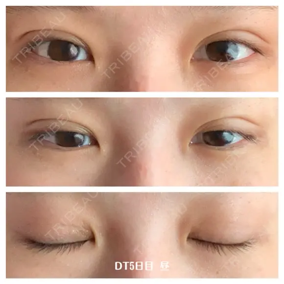 二重埋没 湘南美容クリニック 藤沢院 DAY 5 メイン用