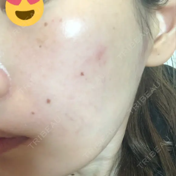 美肌レーザー / シミ取りレーザー たかはし形成外科･美容外科  DAY 4 メイン用