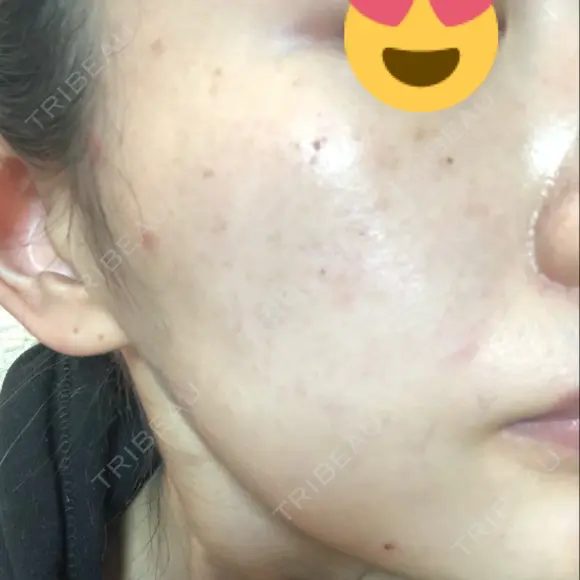 美肌レーザー / シミ取りレーザー たかはし形成外科･美容外科  DAY 4 メイン用