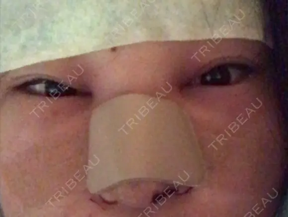 隆鼻術 / 鼻尖形成（切開） / 小鼻縮小（切開） / ほくろ・いぼ切除（肌） / 鼻翼挙上 東京形成美容外科 船橋院 DAY 2 メイン用