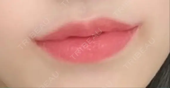 口唇縮小術 / 口角挙上 B-LINE CLINIC 池袋院 DAY 55 メイン用