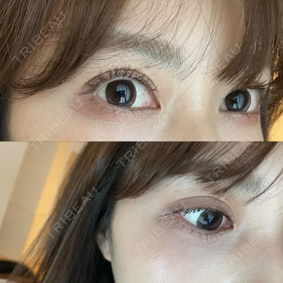 二重切開 ルネッサンス美容外科医院 神戸院 DAY 730 メイン用