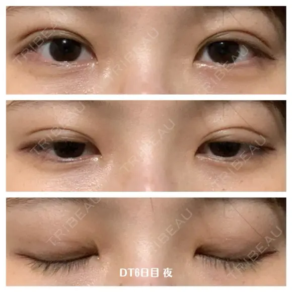 二重埋没 湘南美容クリニック 藤沢院 DAY 6 メイン用