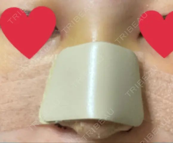 隆鼻術 / 鼻尖形成（切開） / 小鼻縮小（切開） / ほくろ・いぼ切除（肌） / 鼻翼挙上 東京形成美容外科 船橋院 DAY 3 メイン用